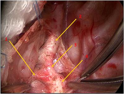 Importance of Acute Anterior Angulation in Double Aortic Arch Needing Attention at Primary Surgery